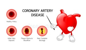 301282f8c335489ecb629c94092d3ab9_heart-character-with-coronary-artery-disease-info-graphic-stock-_800-467